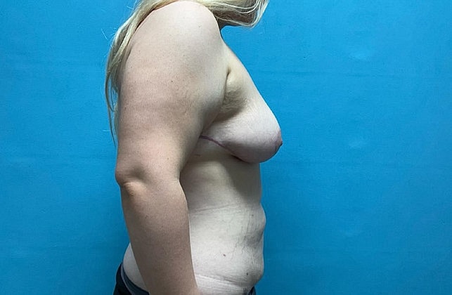 Breast Reduction Before & After