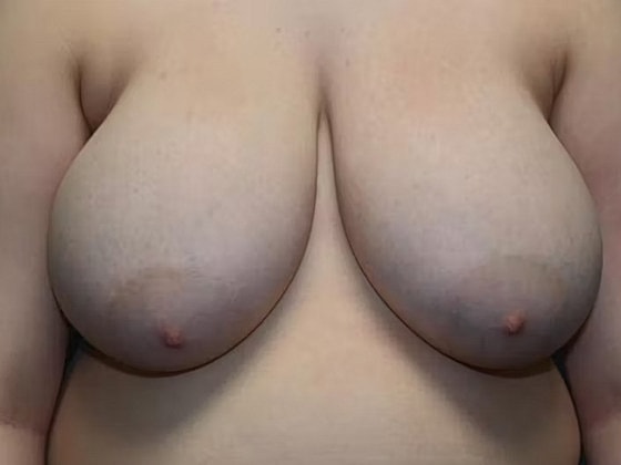 Breast Reduction Before & After