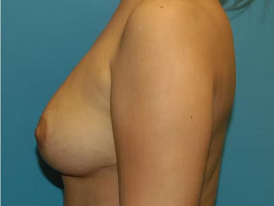 Breast Reduction Before & After