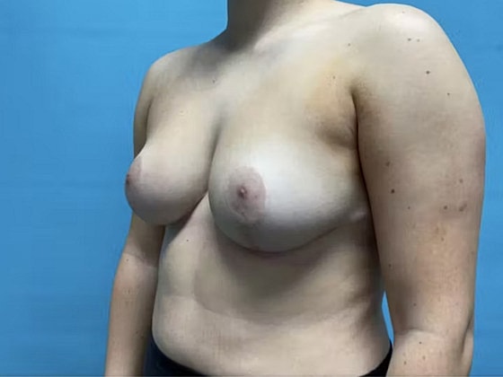 Breast Reduction Before & After