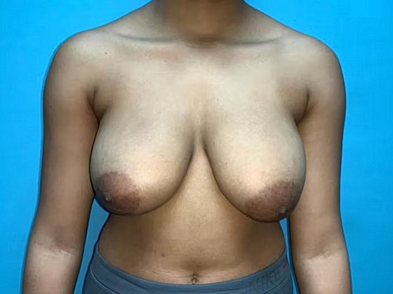 Breast Reduction Before & After