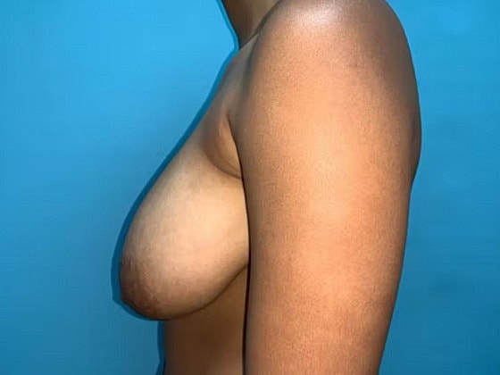 Breast Reduction Before & After