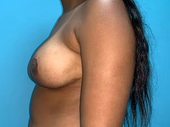 Breast Reduction Before & After