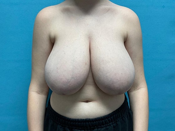 Breast Reduction Before & After