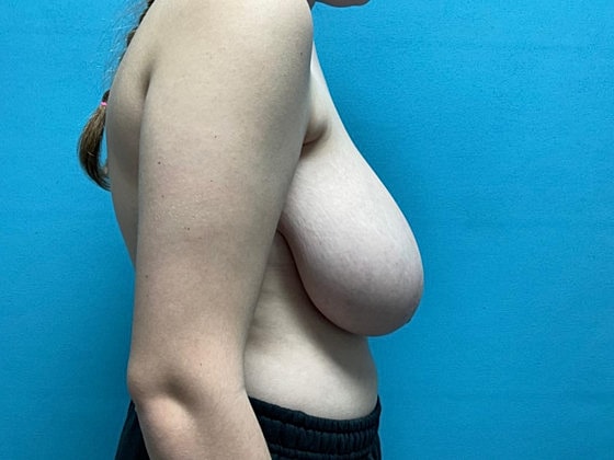 Breast Reduction Before & After