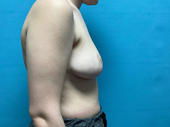 Breast Reduction Before & After