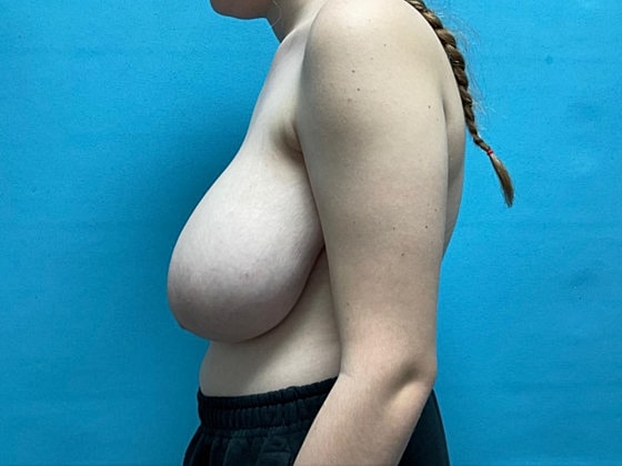 Breast Reduction Before & After