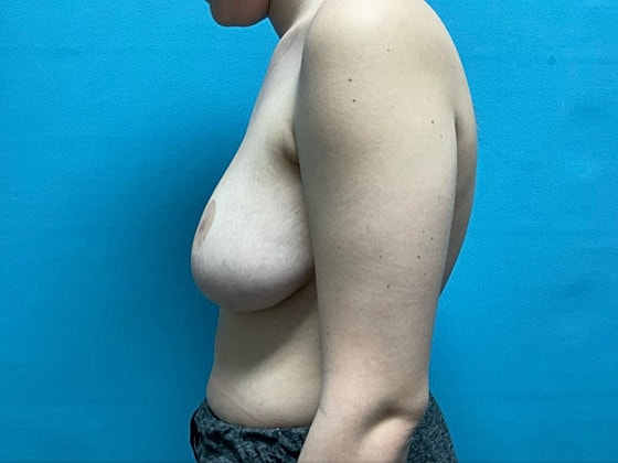 Breast Reduction Before & After