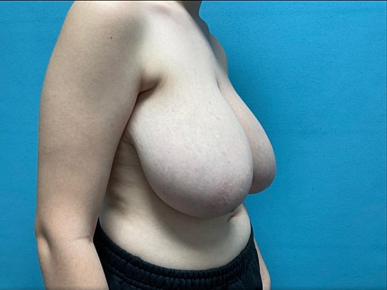 Breast Reduction Before & After
