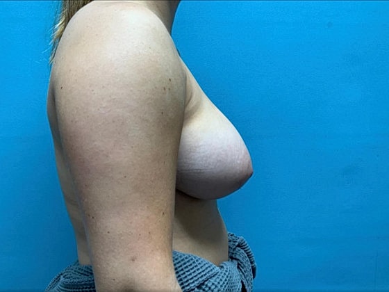 Breast Reduction Before & After