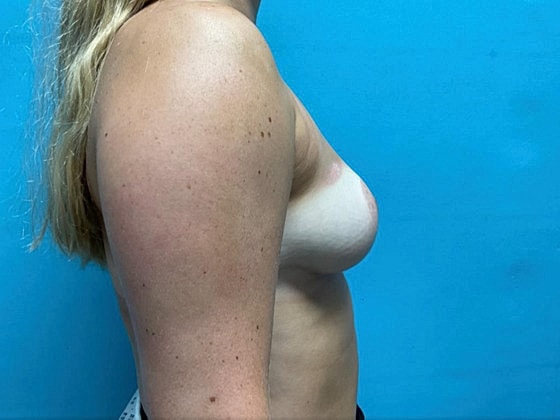 Breast Reduction Before & After