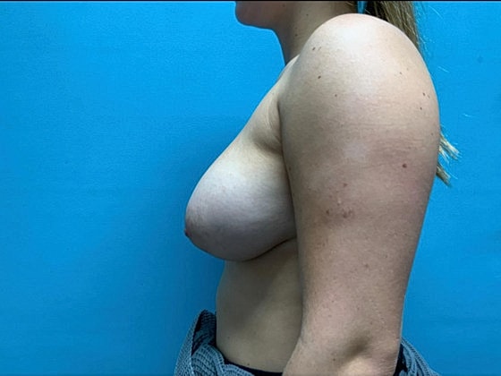 Breast Reduction Before & After
