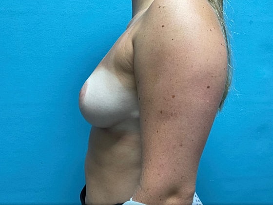 Breast Reduction Before & After