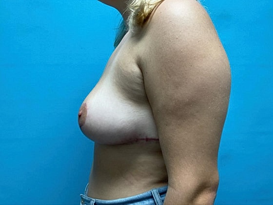 Breast Reduction Before & After