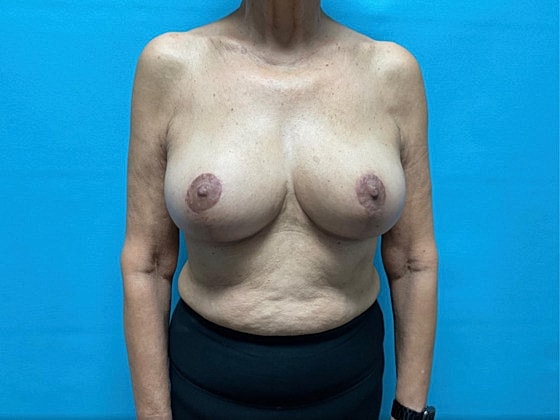 Breast Reduction Before & After