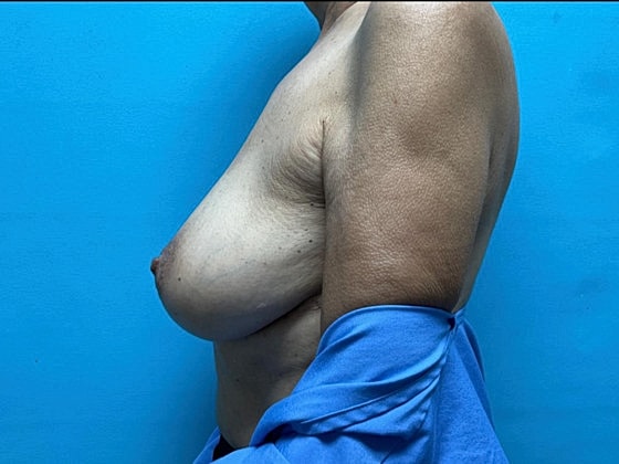 Breast Reduction Before & After