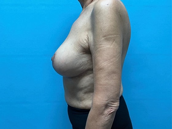 Breast Reduction Before & After