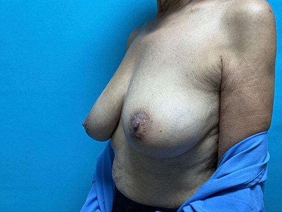 Breast Reduction Before & After