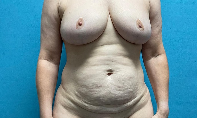Tummy Tuck Before & After