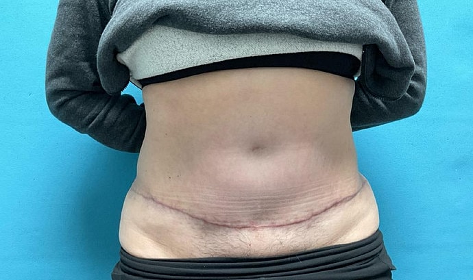 Tummy Tuck Before & After