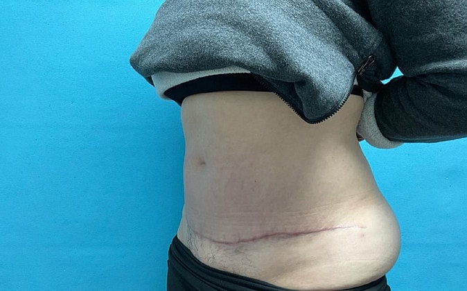 Tummy Tuck Before & After