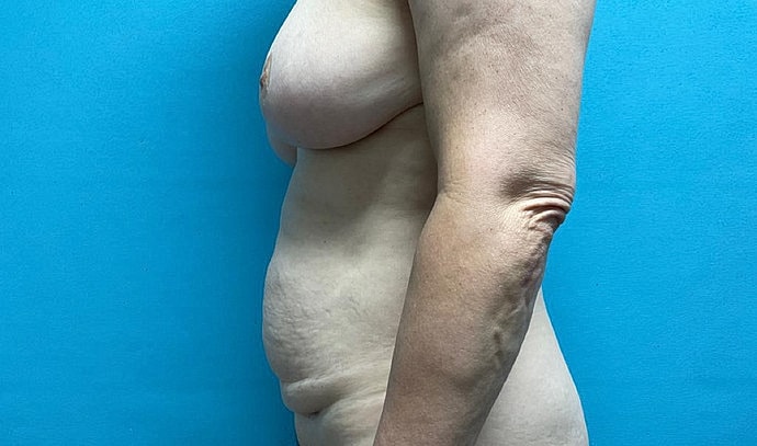 Tummy Tuck Before & After