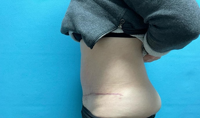 Tummy Tuck Before & After