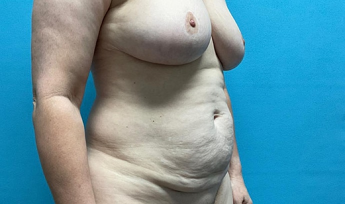 Tummy Tuck Before & After