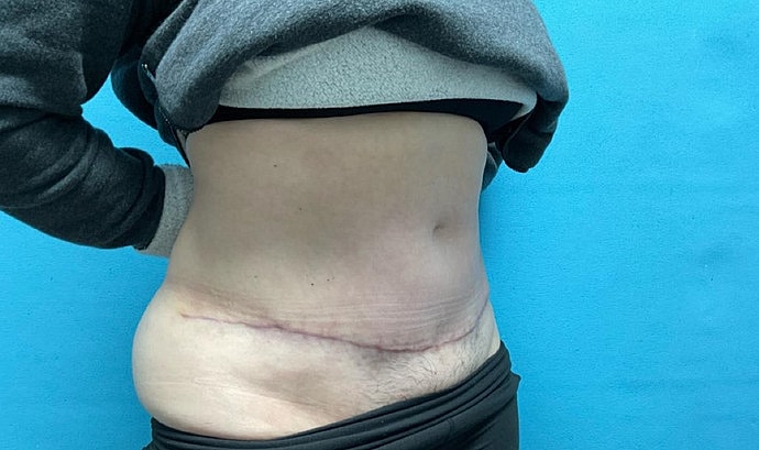 Tummy Tuck Before & After