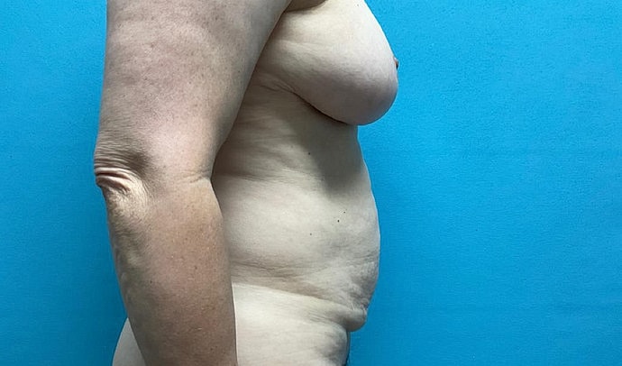 Tummy Tuck Before & After