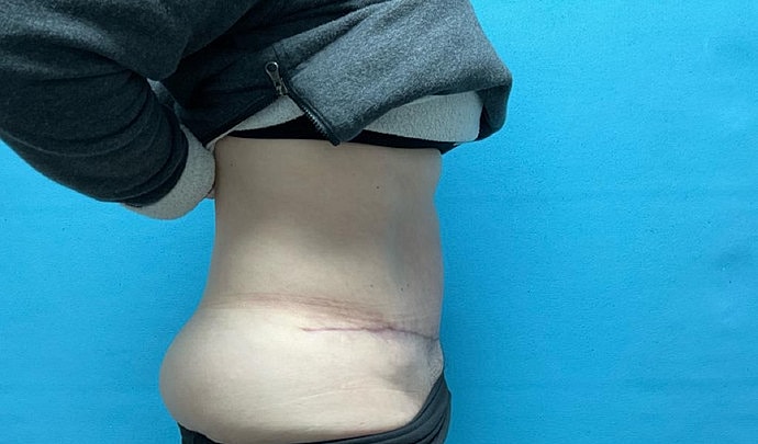 Tummy Tuck Before & After