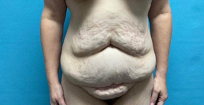 Tummy Tuck Before & After