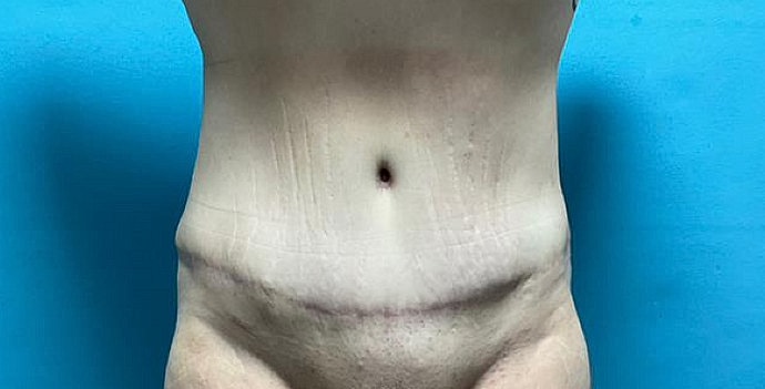 Tummy Tuck Before & After