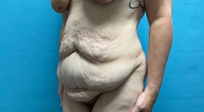 Tummy Tuck Before & After