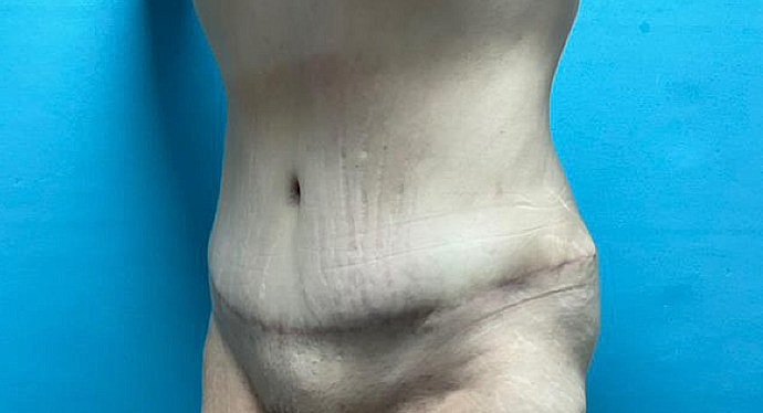 Tummy Tuck Before & After