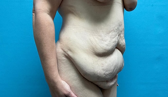 Tummy Tuck Before & After
