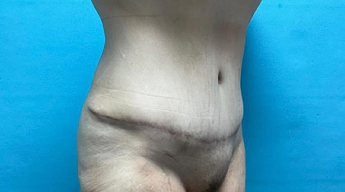 Tummy Tuck Before & After