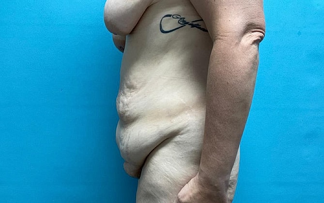 Tummy Tuck Before & After