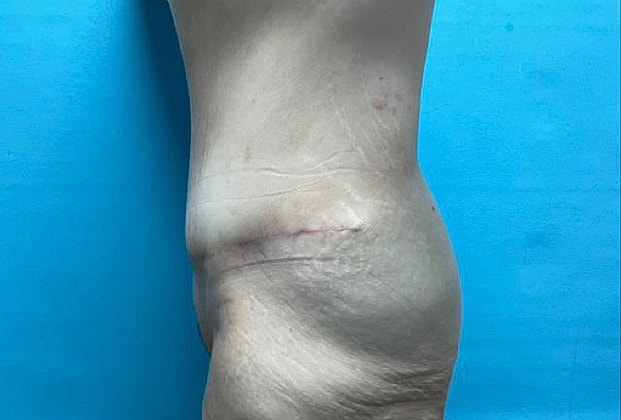 Tummy Tuck Before & After