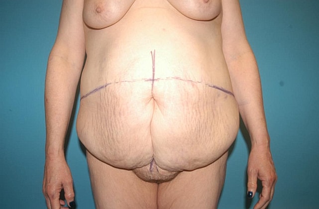 Tummy Tuck Before & After