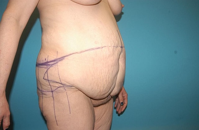 Tummy Tuck Before & After