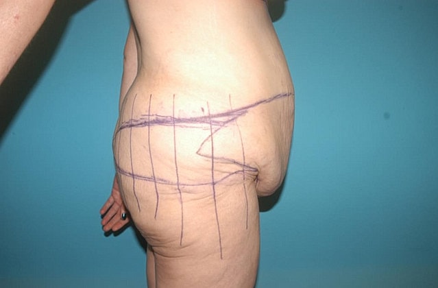 Tummy Tuck Before & After