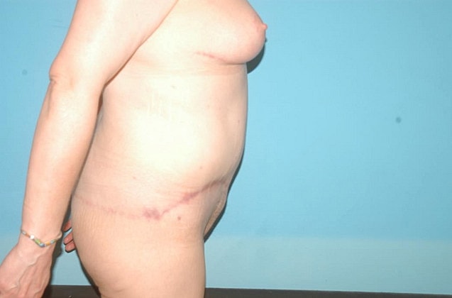 Tummy Tuck Before & After