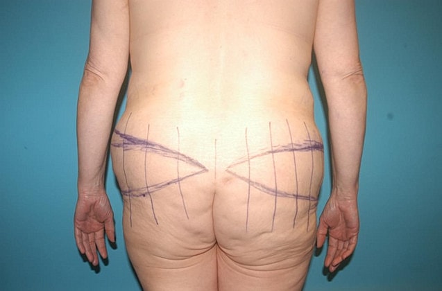 Tummy Tuck Before & After