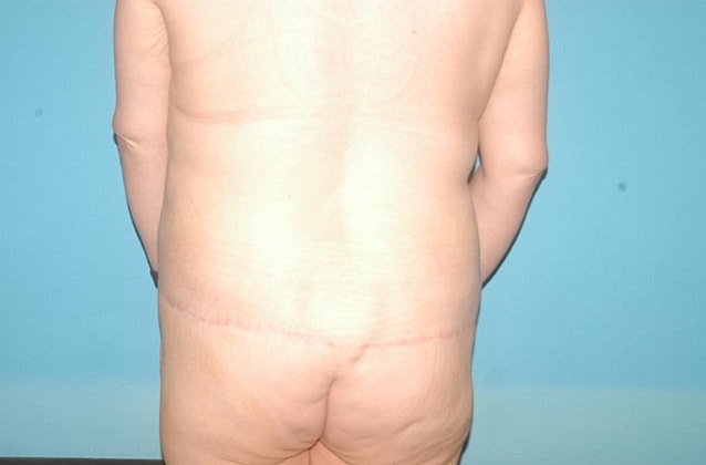 Tummy Tuck Before & After