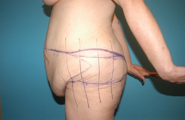 Tummy Tuck Before & After