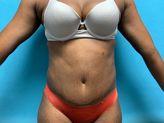 Tummy Tuck Before & After