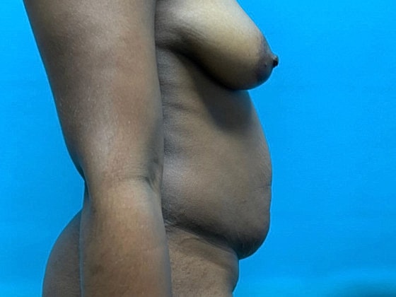 Tummy Tuck Before & After