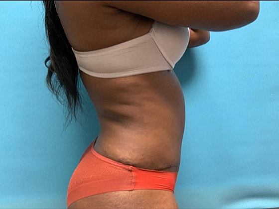 Tummy Tuck Before & After