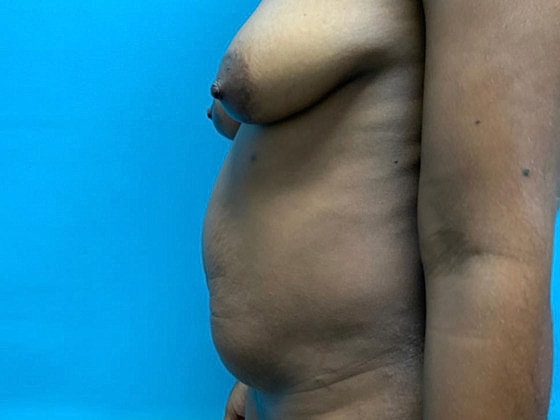 Tummy Tuck Before & After